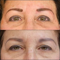 Defined Visage - Saline Tattoo Removal to remove pigment and shrink the shape. Brows were re-done with a more complimentary shape and color.