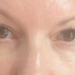 Michael Burnstine, MD - Pasadena Oculoplastic Surgeon - 10 days after surgery