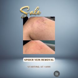 Advance Laser & Cosmetic Surgery - Spider Vein removal !
