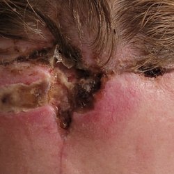 Chung John MD - After stitch removal with severe infection.
