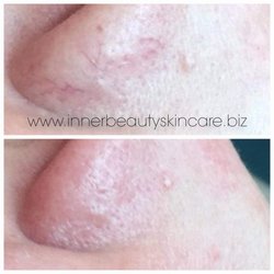 Inner Beauty Skincare - Broken Capillaries Removed with Thermo-Lo Treatment