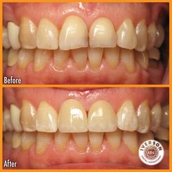 Iverson Dental Labs - A patient showing severe wear and tear on their teeth in the "before" image, now beaming with a rejuvenated and youthful smil...