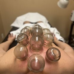 Chosen Acupuncture - Cupping