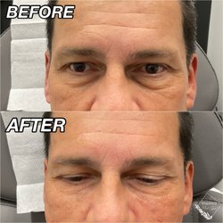 Inspired Med Spa - Tear trough filler