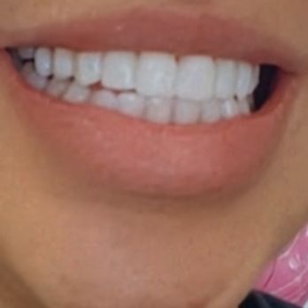 CG Smile - Beautiful Temporary veneers - Cosmetic Dentists Near Me - Miami, Florida CG Smile - Beautiful Temporary veneers - Cosmetic Dentists Near Me - Miami, Florida