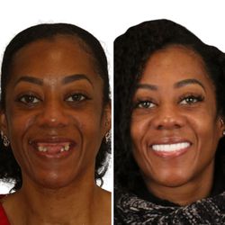 Britely Dentures + Implants Studio - Final result of full mouth dental implants!