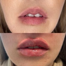 Nurse Tammy is very skilled in the art of lip injections. My lips have never been better . I can't imagine going anywhere else for my lips. Nurse Tammy is very skilled in the art of lip injections. My lips have never been better . I can't imagine going anywhere else for my lips.