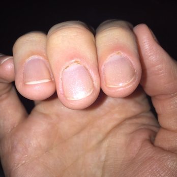 Organic Nails & Spa - This is what my fingers looked like the following day. My cuticles are still inflamed... also, she polished over the dried blood - Nail Salons Near Me - Georgetown, Texas