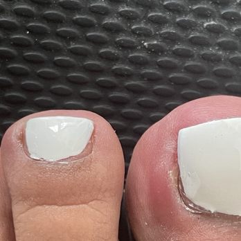 Happy Nails & Spa 6 - Big toe got cut and infected. You can see the difference in skin color from the infection and swelling - Nail Salons Near Me - Palmdale, California Happy Nails & Spa 6 - Big toe got cut and infected. You can see the difference in skin color from the infection and swelling - Nail Salons Near Me - Palmdale, California