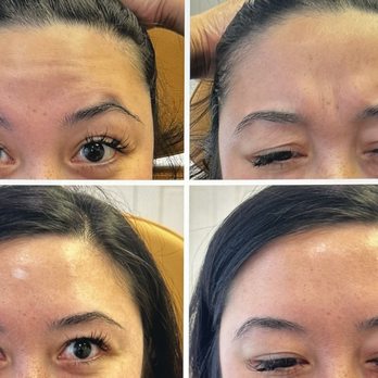 Enaira Medical Aesthetics - Before and after (3 weeks) - Medical Spas Near Me - Vallejo, California Enaira Medical Aesthetics - Before and after (3 weeks) - Medical Spas Near Me - Vallejo, California