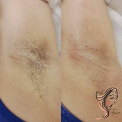 Sweet Faces Esti - Before and After Underarms Wax Service.