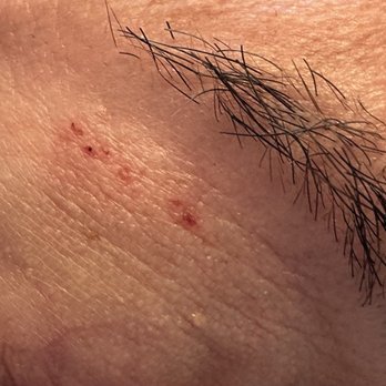 Ziba Beauty - Multiple cuts that burn. - Waxing Near Me - Daly City, California Ziba Beauty - Multiple cuts that burn. - Waxing Near Me - Daly City, California