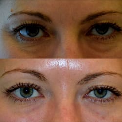 Visage Sculpture - Non-Surgical Blepharoplasty (Eye Lift) with Restylane and Sculptra