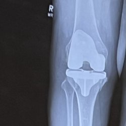 Amory David MD - The "after". My perfect knee!!