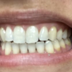 Apex Dental Care - My teeth after being cleaned right in Clarksville, TN.