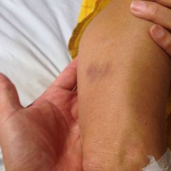 Flushing Manor Care Center - Checked my moms body and found bruises after another patient told me she witnessed employees pinching and hitting the patients.