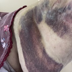 Fresenius Kidney Care -Eugene - Photo of my arm the day after