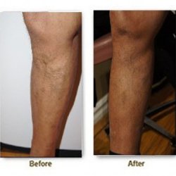 Metropolitan Vein and Aesthetic Center - Varicose veins before and after