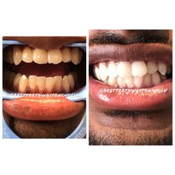 Upgrade your smile in just 1 hour with our Best teeth whitening experience.