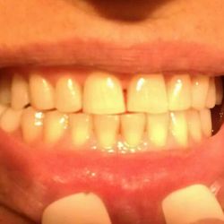 Gentle Dental Fam Dentistry - Before Veneers.....