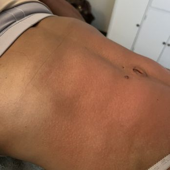 Lipo Lounge JAX - My abdomen post Endoluxx (cellulite) treatment 1 on June 13th w/Kamillah; she also treated my thighs, hamstrings, and glutes/buttock. - Weight Loss Centers Near Me - Jacksonville, Florida Lipo Lounge JAX - My abdomen post Endoluxx (cellulite) treatment 1 on June 13th w/Kamillah; she also treated my thighs, hamstrings, and glutes/buttock. - Weight Loss Centers Near Me - Jacksonville, Florida