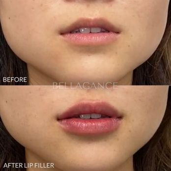 Bellagance - Lip filler treatment by PA Tancora. - Medical Spas Near Me - Beverly Hills, California Bellagance - Lip filler treatment by PA Tancora. - Medical Spas Near Me - Beverly Hills, California