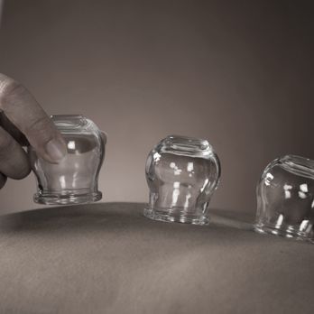 M Acupuncture - Cupping is good for muscle pain, emotional distress, and detoxifying the body. - Acupuncture Near Me - San Francisco, California M Acupuncture - Cupping is good for muscle pain, emotional distress, and detoxifying the body. - Acupuncture Near Me - San Francisco, California