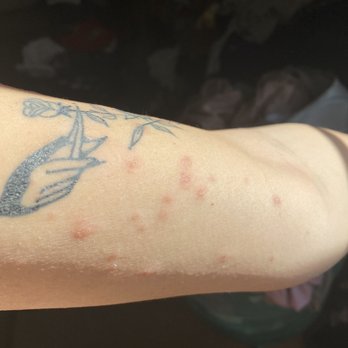 Cobra Custom Tattoo - Staph infection - Tattoo Near Me - Plymouth, Massachusetts