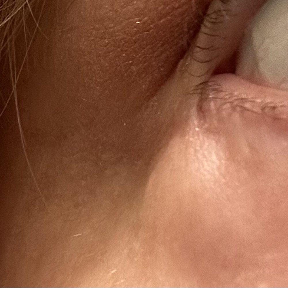 Leo Urbinelli - C shaped scarring/pocket caused by incorrect positioning and round puffy spot. - Cosmetic Surgeons Near Me