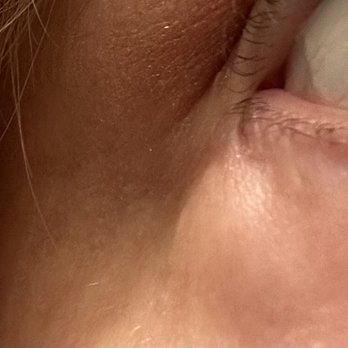Leo Urbinelli - C shaped scarring/pocket caused by incorrect positioning and round puffy spot. - Cosmetic Surgeons Near Me Leo Urbinelli - C shaped scarring/pocket caused by incorrect positioning and round puffy spot. - Cosmetic Surgeons Near Me