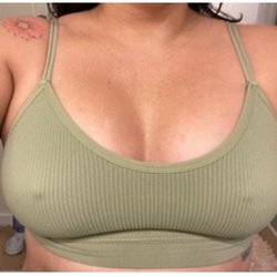 W. Tracy Hankins, MD - JAN 19, 2021 6WKS POST-OP