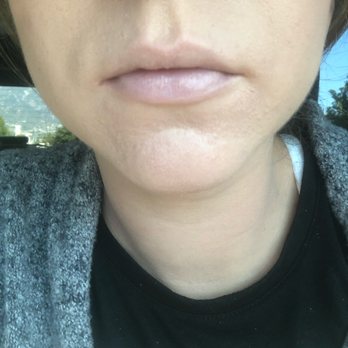 Bella Aesthetics - Before - Cosmetics & Beauty Supply Near Me - Rancho Cucamonga, California