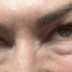 Botched Tear trough filler