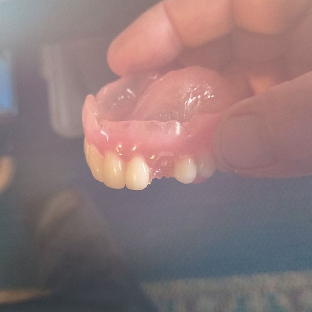 Washington Dental Clinic - Faulty Dentures #3 - General Dentistry Near Me - Tijuana, BCN