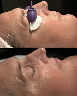 how to iv push glutathione Glutathione Push IV Therapy
