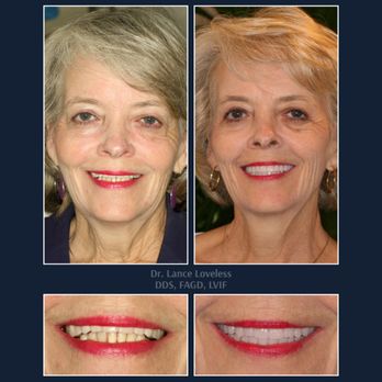 Bridgeview Dental - Smile Makeover Before & After

Dr. Lance Loveless, DDS, FAGD, LVIF
Dentist in Austin, TX
Bridgeview Dental
3801 N Capital of ... - General Dentistry Near Me - Austin, Texas