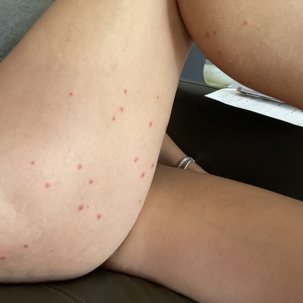 Emerald Beach Resort - Scabies bites! - Hotels Near Me - Charlotte Amalie West, Virgin Islands Emerald Beach Resort - Scabies bites! - Hotels Near Me - Charlotte Amalie West, Virgin Islands