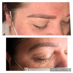 UVO Beauty - Crows feet (around eyes ) botox