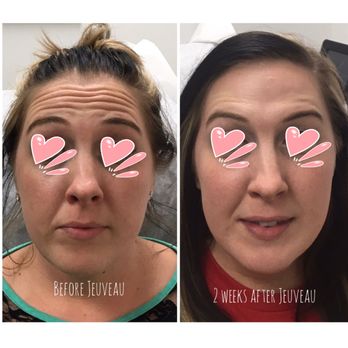 Beauty and Butterflies Med Spa - Before & After NeuroModulator Jeuveau - Medical Spas Near Me - Apache Junction, Arizona Beauty and Butterflies Med Spa - Before & After NeuroModulator Jeuveau - Medical Spas Near Me - Apache Junction, Arizona