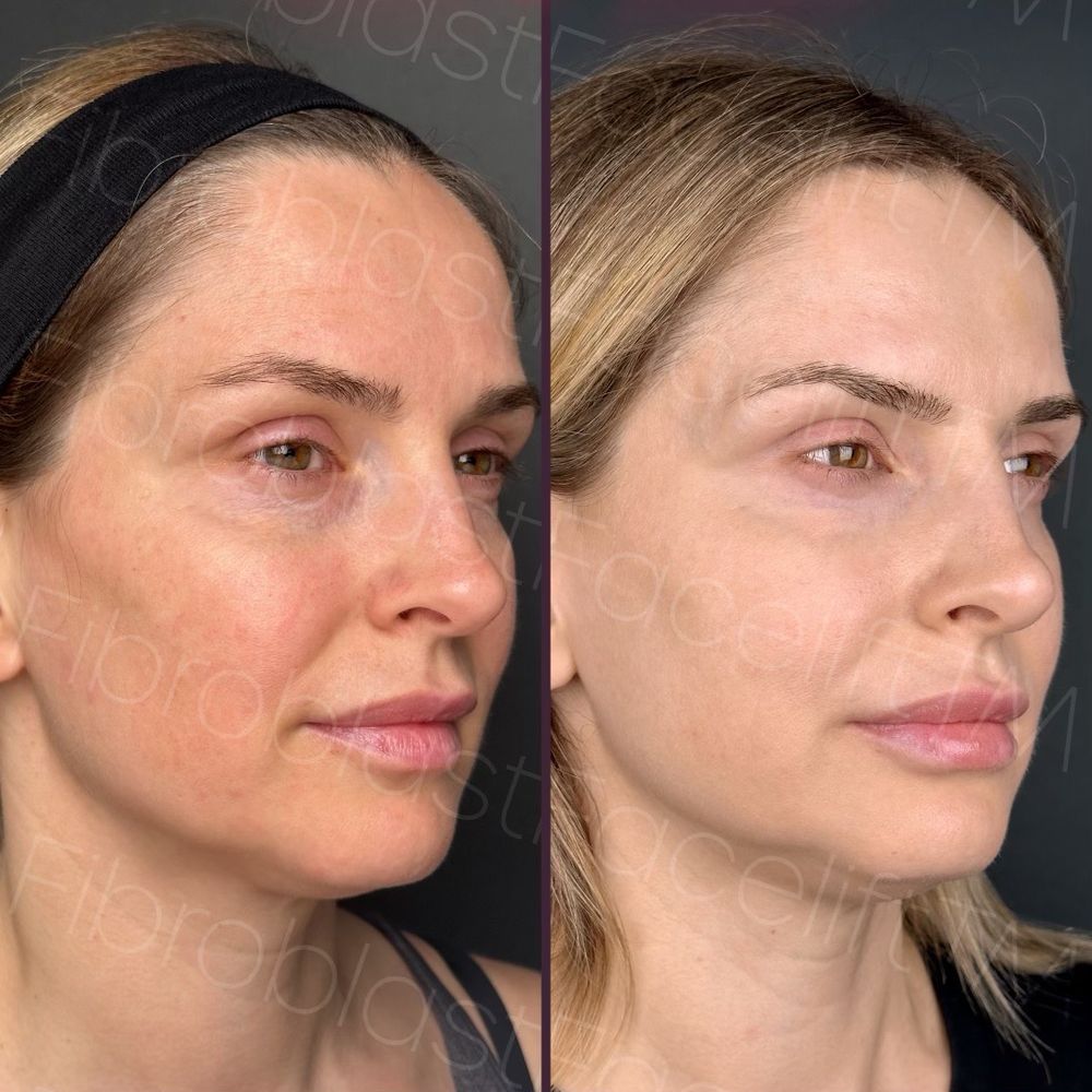 Fibroblast Facelift - Before/After - Skin Care Near Me - Pasadena, California