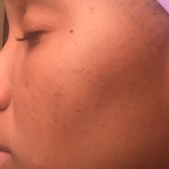 Sanova Dermatology North Austin - Week 7 of following the acne regime - Dermatologists Near Me - Austin, Texas Sanova Dermatology North Austin - Week 7 of following the acne regime - Dermatologists Near Me - Austin, Texas