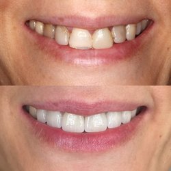 Alex Kalmanovich, DDS - Laguna Family Dentistry - Crowns and veneers