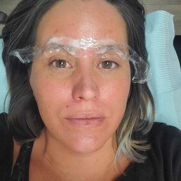 Numbing cream being added to my face!