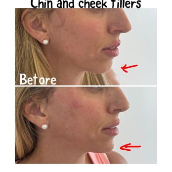 Diamond Med Spa - Chin fillers and PDO threads - Medical Spas Near Me - Miami Beach, Florida Diamond Med Spa - Chin fillers and PDO threads - Medical Spas Near Me - Miami Beach, Florida
