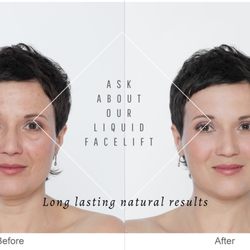 South County Microspa - Liquid FaceLift- No surgery- No downtime!