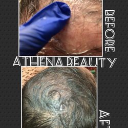 Hair Restoration Men and Women