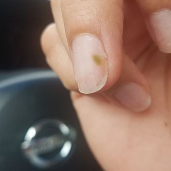 Lux Nailspa - Fungus on my nail after acrylics at Lux (index finger) - Nail Salons Near Me - Hawthorne, California Lux Nailspa - Fungus on my nail after acrylics at Lux (index finger) - Nail Salons Near Me - Hawthorne, California