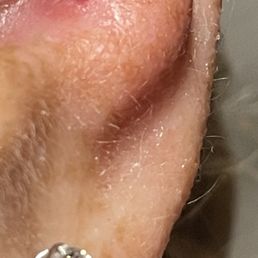The slit caused by the crooked piercing that was too close to the edge. The slit caused by the crooked piercing that was too close to the edge.