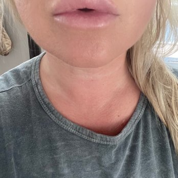 Pretty Please By KT - 2 weeks after filler - Skin Care Near Me Pretty Please By KT - 2 weeks after filler - Skin Care Near Me