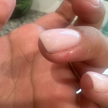 Noor Nail Bar - The hole in my finger from drill - Nail Salons Near Me - Manhattan Beach, California